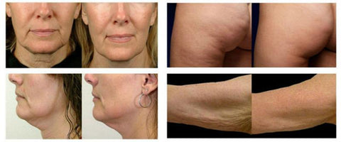 THERMAGE FACIAL RF RADIO FREQUENCY FOR FACE LIFTING