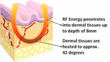 THERMAGE FACIAL RF RADIO FREQUENCY FOR FACE LIFTING